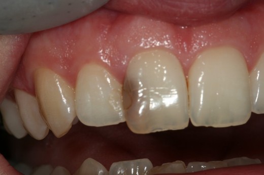 Bílá plomba přední zub 1