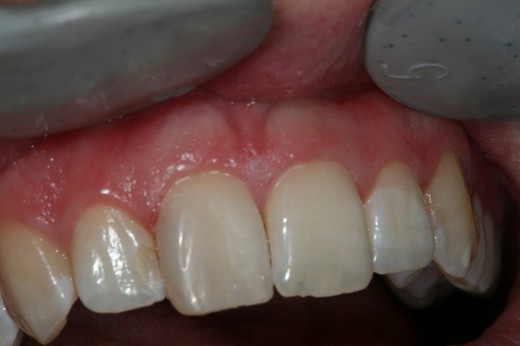 Bílá plomba přední zub 2