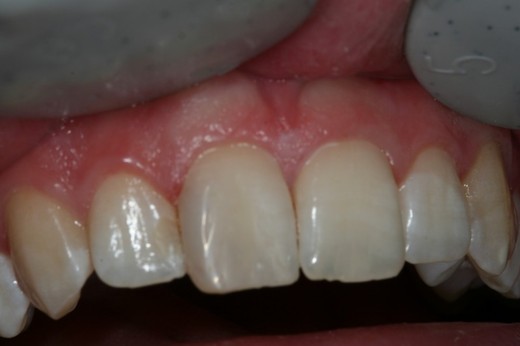 Bílá plomba přední zub 3