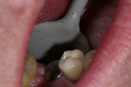 Implantát 1
