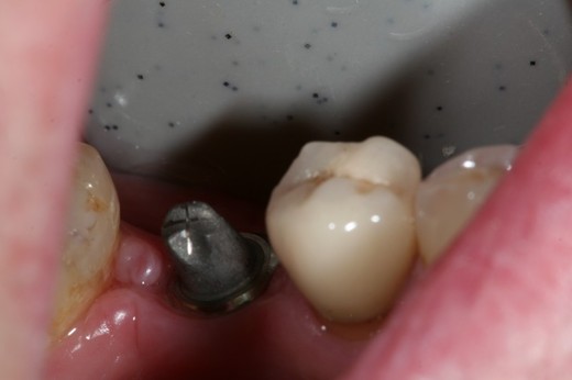 Implantát 2