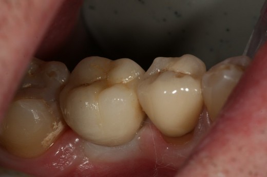 Implantát 3